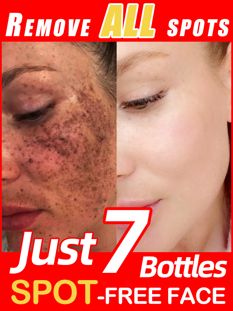 Luxury Skincare Essence - Mencerahkan Bintik-Bintik, Melasma, Flek Hitam di